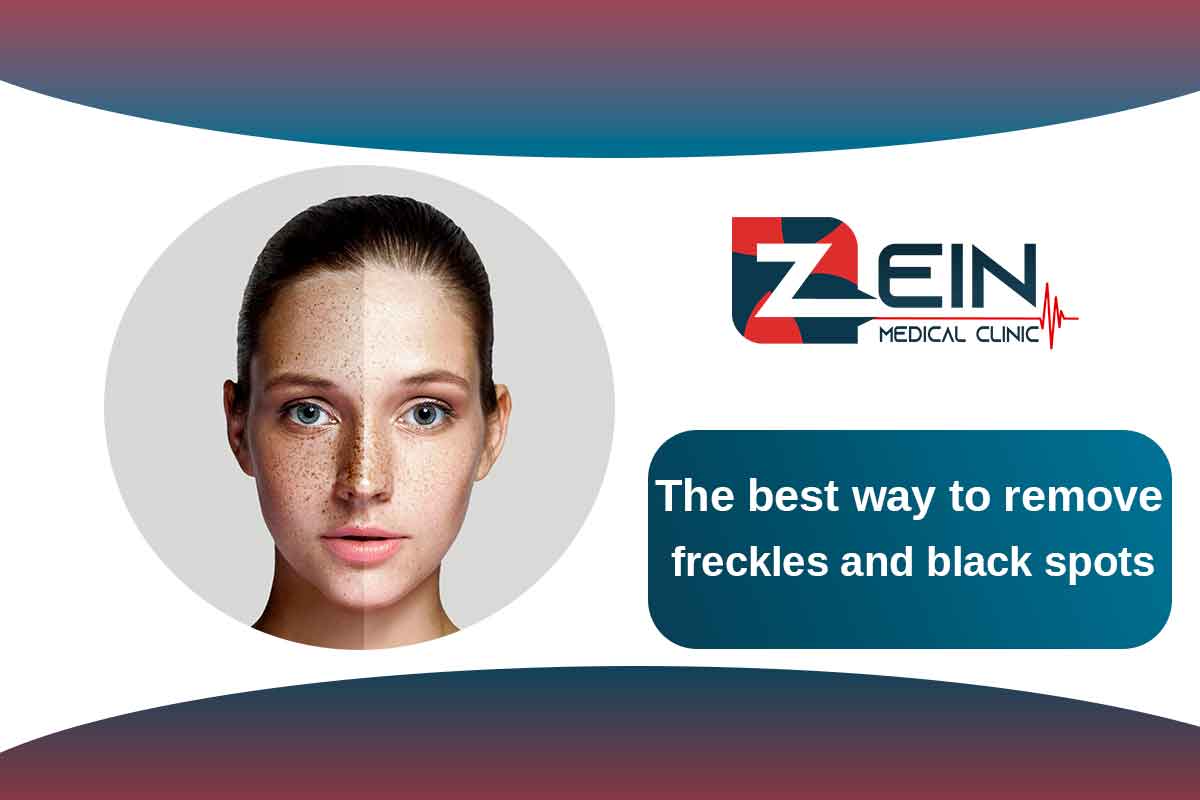 the-best-way-to-remove-freckles-and-black-spots-zein-hospital