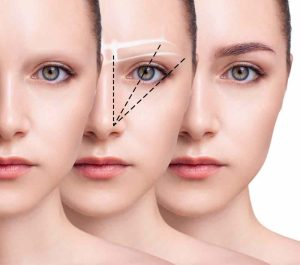 The most important techniques of eyebrow hair transplantation at Zein Clinic