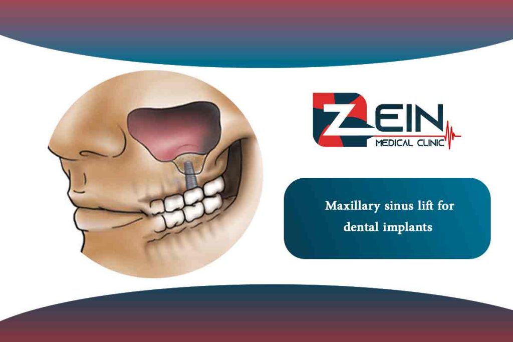 Maxillary Sinus Lift For Dental Implants Zein Hospital