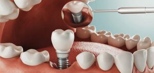 What are the possible risks after dental implants?