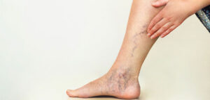 What are the reasons for the appearance of varicose veins?