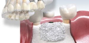 What is bone grafting and how is It done?
