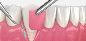 What is gum Implantation?