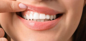 What are the benefits of gum implants?
