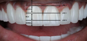 The coordination of teeth and gums for an attractive smile