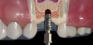 Techniques for Elevating the Periodontal Pocket
