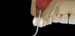 Surgical maxillary jaw lift: