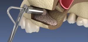 Lifting the jaw pocket without surgery:
