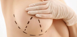 Breast Lift Surgical Procedures