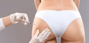 Buttocks enlargement by fillers